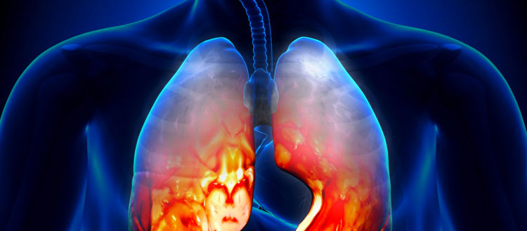 Treatment for Pneumonia | What Are the Symptoms of Pneumonia?